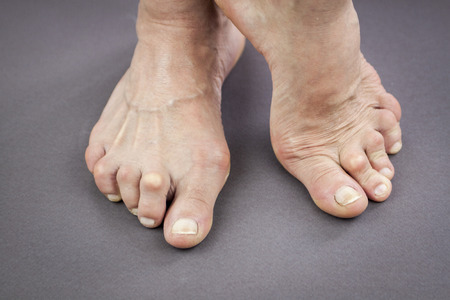 Feet Of Woman Deformed From Rheumatoid Arthritis. の写真素材