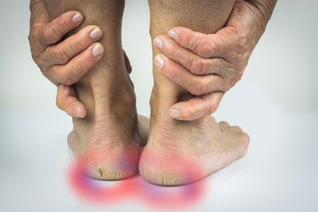Cracked heels and hands. Pain denoted by the red colour