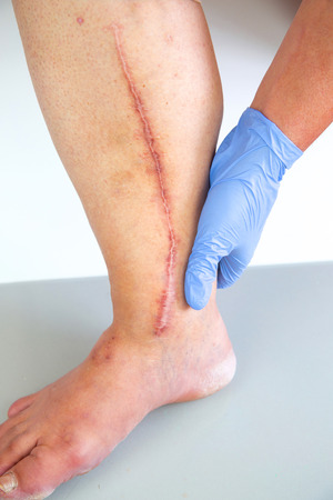 Human leg with postoperative scar of cardiac surgery. Medical concept. Heart diseaseの写真素材