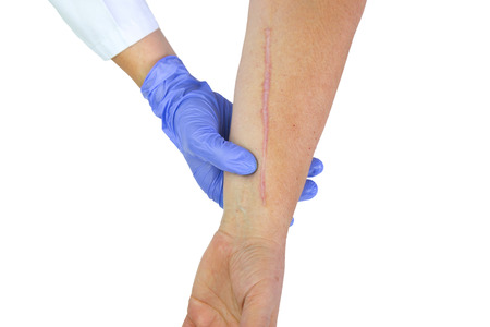 Human arm with postoperative scar of cardiac surgery. Medical concept. Heart disease. Isolated