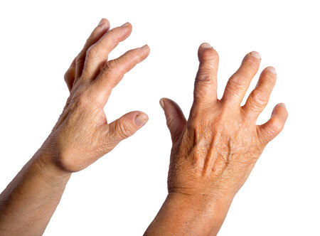 Hand Deformed From Rheumatoid Arthritis. Studio shot. Pain condition. Isolated on white Hand Deformed From Rheumatoid Arthritis. Studio shot. Pain condition. Isolated on white