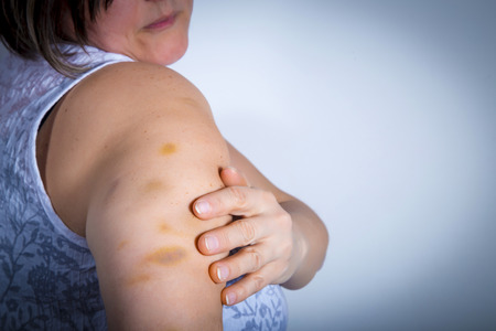 Adult patient showing bruises on her upper arm from intravenous therapy. Diabetic. Insulinの写真素材