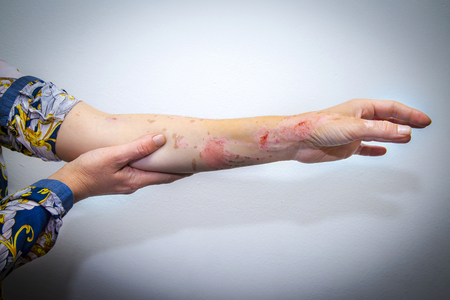 Human arm with severe burns on the skinの写真素材