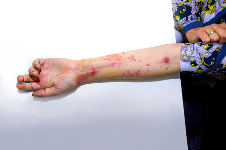 Human arm with severe burns on the skinの写真素材