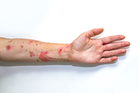 Human arm with severe burns on the skinの写真素材