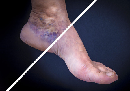 Adult woman foot with varicose veins before and after treatment on dark background