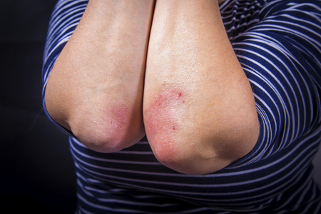 Psoriasis on lady's elbow on dark background. Close upの写真素材