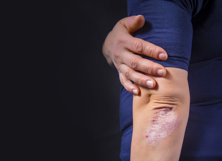 Psoriasis on lady's elbow on dark background. Close up