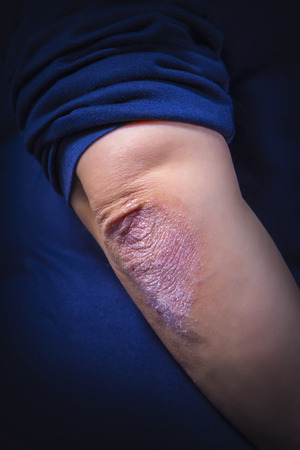 Psoriasis on lady's elbow on dark background. Close upの写真素材