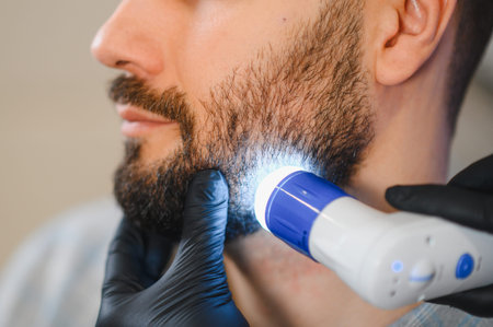 Professional performing laser hair removal on a man's face for permanent hair reduction, male grooming and aesthetic procedureの写真素材