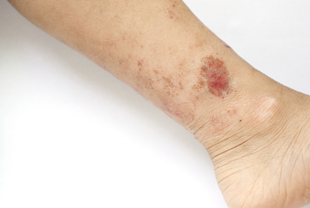 Eczema rash wound on the skin of a kid's leg
