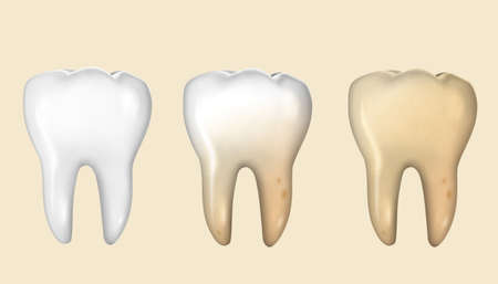 Teeth set from clean to dirty process, isolated on light yellow background, 3d illustrationのイラスト素材
