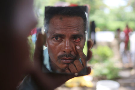 NEW DELHI, INDIA - JULY 24: Flood affected people living in temporary tent sites are suffering with Eye Flu, at Vikas Marg ITO, on July 24, 2023 in New Delhi, India. (Photo by Salman Ali/Hindustan Times )のeditorial素材