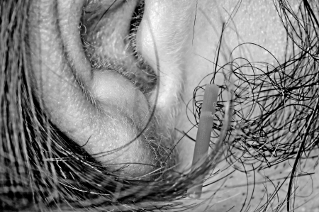 acupuncture treatmentの写真素材