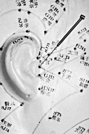 acupuncture needle on modelの写真素材