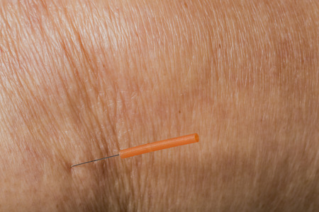 acupuncture treatment on legの写真素材