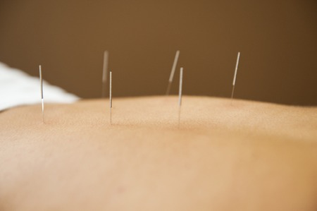 Acupuncture therapyの写真素材