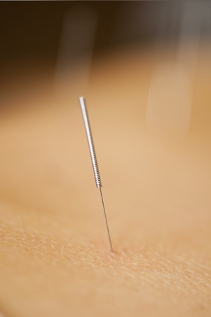 Acupuncture therapyの写真素材
