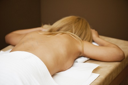 Acupuncture therapyの写真素材