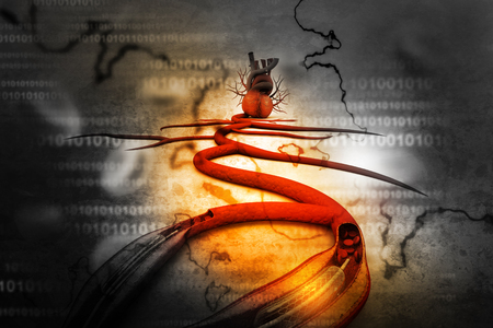 Stent angioplasty procedure with placing a balloonの写真素材