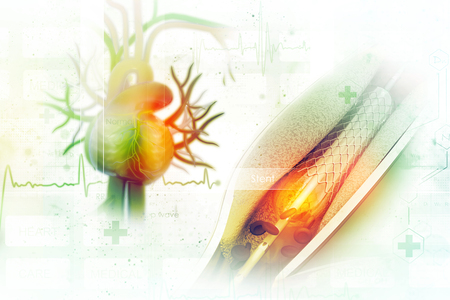 Stent angioplasty procedure with placing a balloonの写真素材