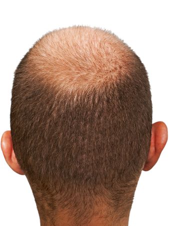 Bald hair head of adult men completely baldingの写真素材