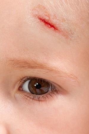 Physical injury blood wound skin human child painの写真素材