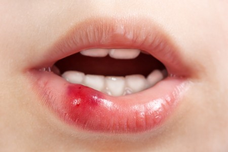 Physical injury blood wound human child mouth lipの写真素材