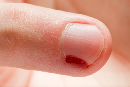 Physical injury blood wound human hand finger nailの写真素材