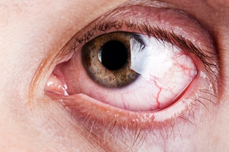 Medicine healthcare blood capillary human eye painの写真素材