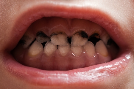 Dental medicine and healthcare - human patient open mouth showing caries teeth decayの写真素材