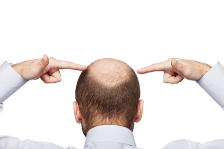 Human alopecia or hair loss - adult man hand pointing his bald headの写真素材
