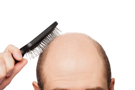 Human alopecia or hair loss - adult man hand holding comb on bald headの写真素材