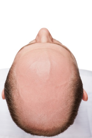 Human alopecia or hair loss - adult man bald head top viewの写真素材