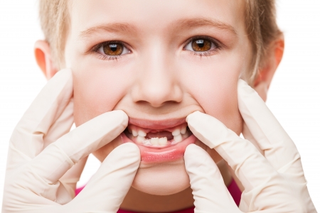 Dental medicine and healthcare - child patient open mouth showing first baby milk or temporary teeth fall outの写真素材