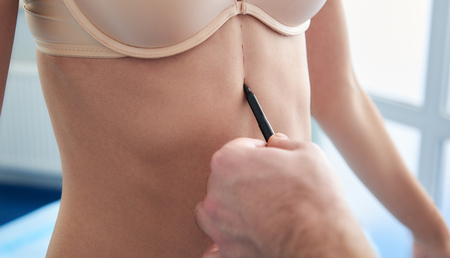 Close up photo of plastic surgeon drawing marks with marker on female patient bodyの写真素材