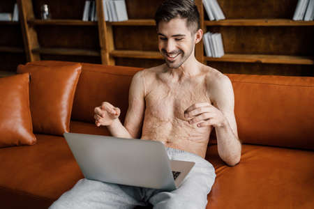 Boy with scars at the skin after burn sitting on couch at home and talking with friendの写真素材