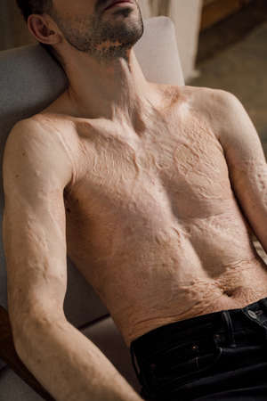 Nan with scars at the skin after burn laying at the armchair and relaxing