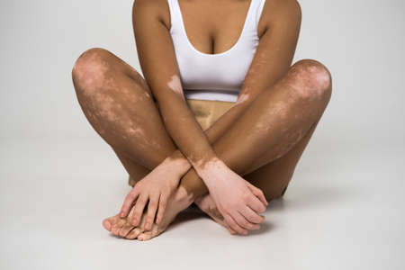 Vitiligo skin woman sitting legs crossed at the studioの写真素材