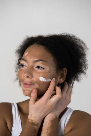 Woman with vitiligo skin applying moisturizer at her face with her fingerの写真素材