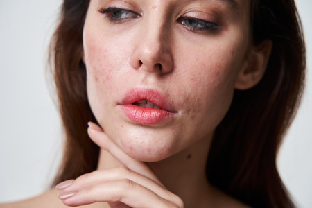 Beautiful brunette woman with bad skin condition looking away while standingの写真素材