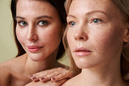 Brunette woman with problematic skin and with naked shoulders bonding to freckled womanの写真素材