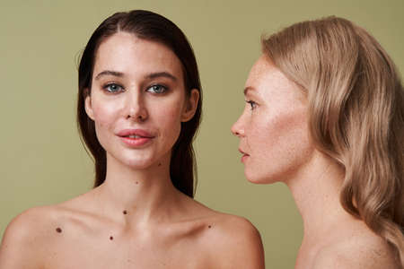 Woman with post acne spots looking at the camera attentively while girl standing nearbyの写真素材