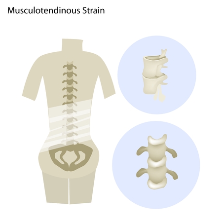Medical Concept Illustration of Musculotendinous Strain Back Ache or Lumbar Pain.のイラスト素材