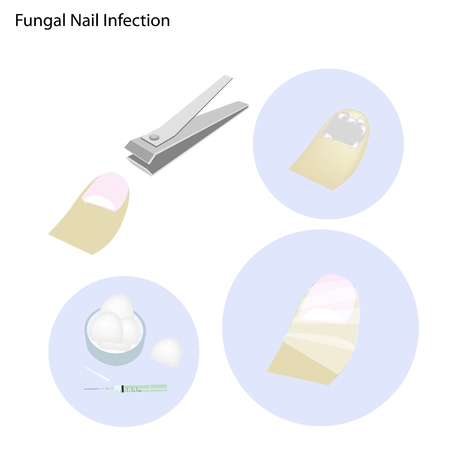 Medical Concept Illustration of Fungal Nail Infection and Part of The Treatment Process.のイラスト素材