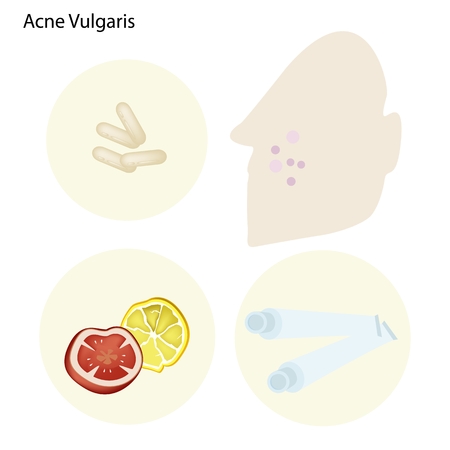 Medical Concept Illustration of Acne Vulgaris and Many Part of The Facial Treatment Process.のイラスト素材
