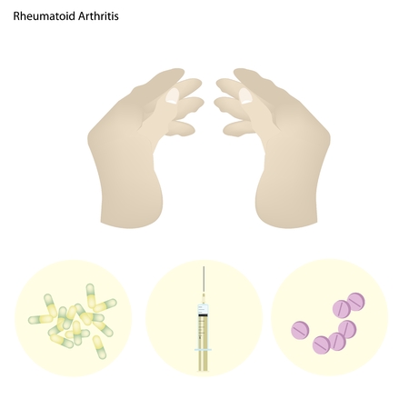 Medical Concept Illustration of Rheumatoid Arthritis of Bone and Cartilage with Medical Treatments.のイラスト素材