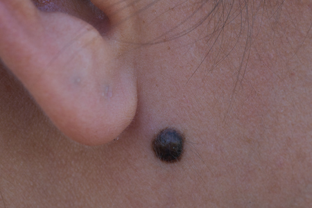 Nevus or mole under the ears of Asian women.の写真素材