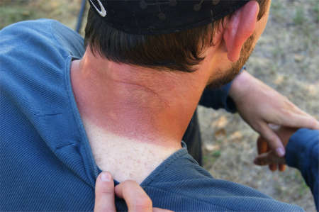 Severe sunburn on the neck of a young man. An abrupt transition from normal skin to burnt skin.