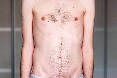 muscular dystrophy of a man with a protrusion of the abdomenの写真素材